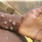 WHO Launches Emergency Response as Mpox Outbreak Worsens in DRC
